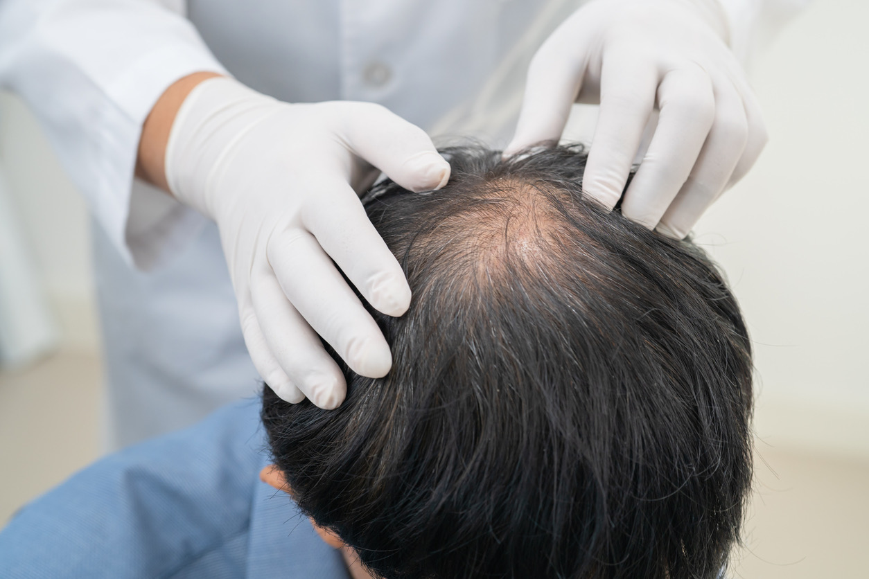 Hair growth article DHT section